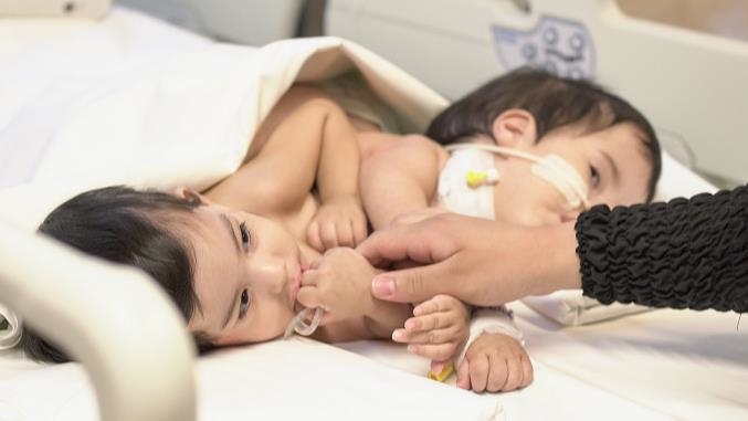 فصل توأمين سياميين جزائريين في عملية استغرقت 9 ساعات