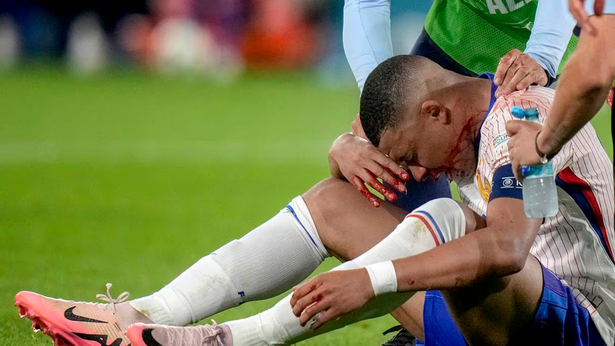 هل يُخرج “أنفُ” مبابي “الديوك” من حسابات لقب “يورو 2024″؟