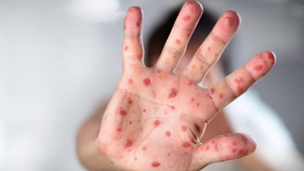 الصحة العالمية تخطط لاحتواء تفشي جدري القردة