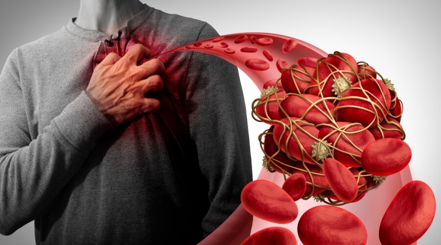 علماء يطورون تقنية جديدة لتجنب الجلطات الدموية وتصلب الشرايين