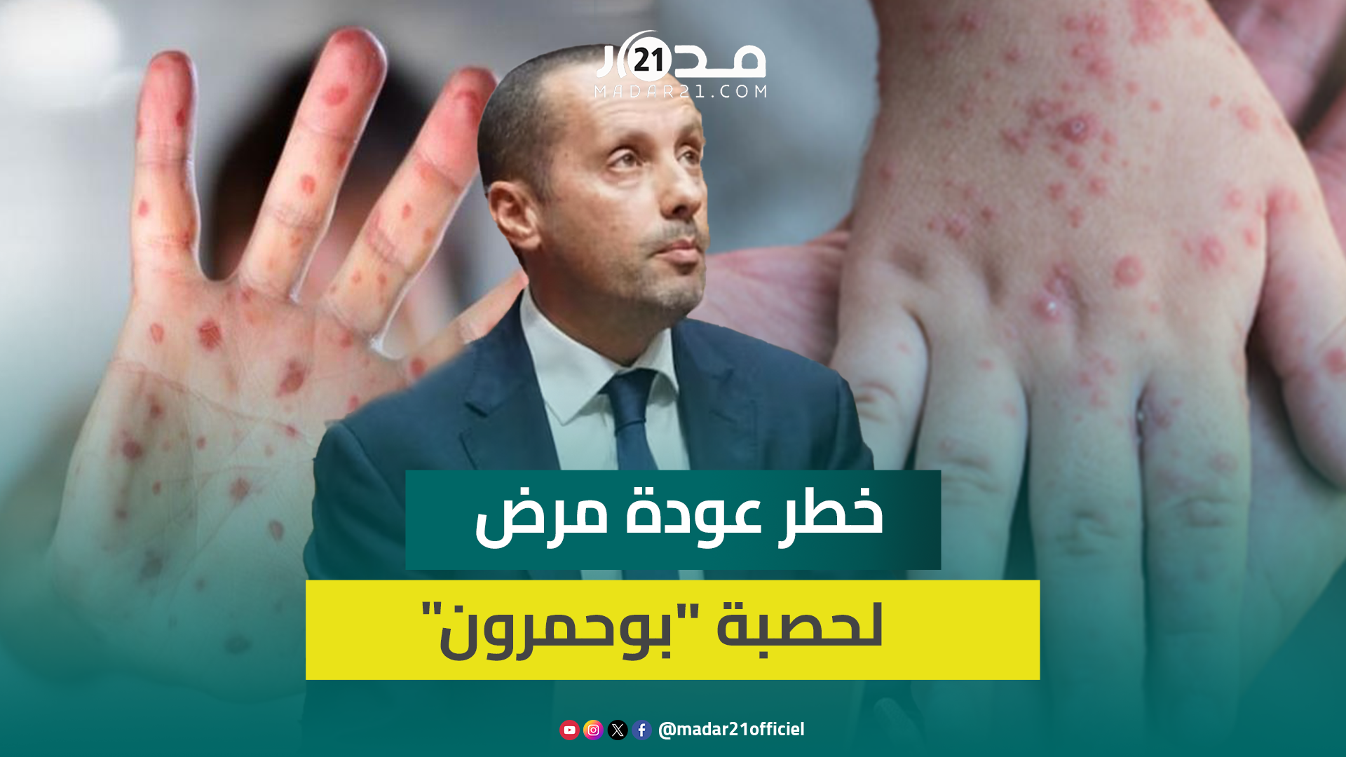 وزير الصحة يسلط الضوء على خـ ـطر عودة مرض الحصبة”بوحمرون”ويكشف عن زيادة وفـ ـيات الأطـ ـفال دون12سنة