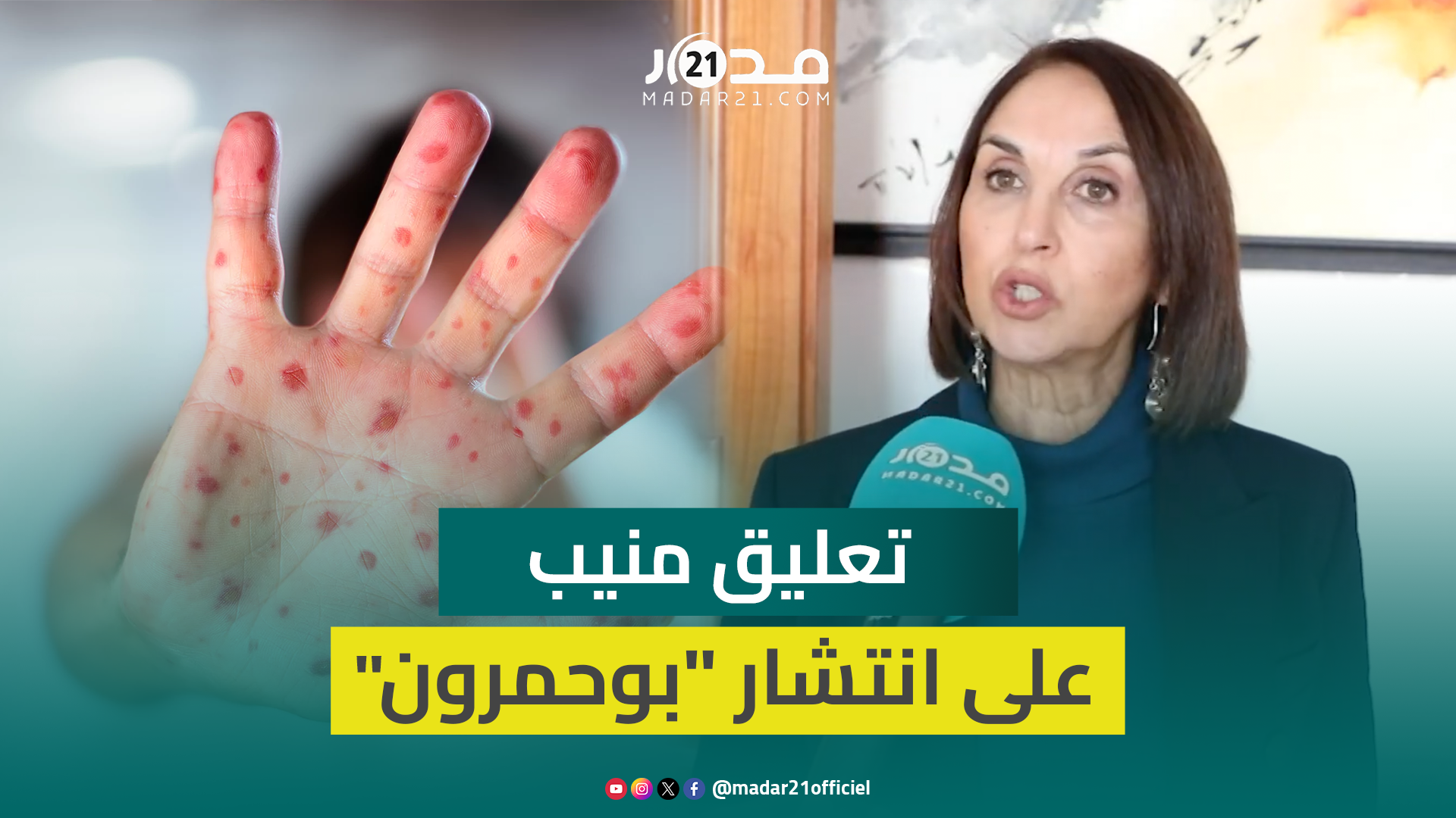 منيب عن “بوحمرون”: المغاربة تفاجأوا بظهور هذا المرض رغم توفر اللقاح وصمت وزارة الصحة “خلانا حايرين”