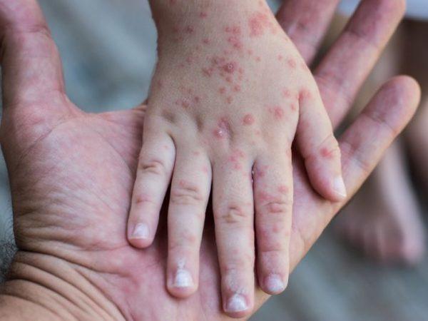 سيدي سليمان تسجل حالة وفاة لطفلة بـ”بوحمرون”