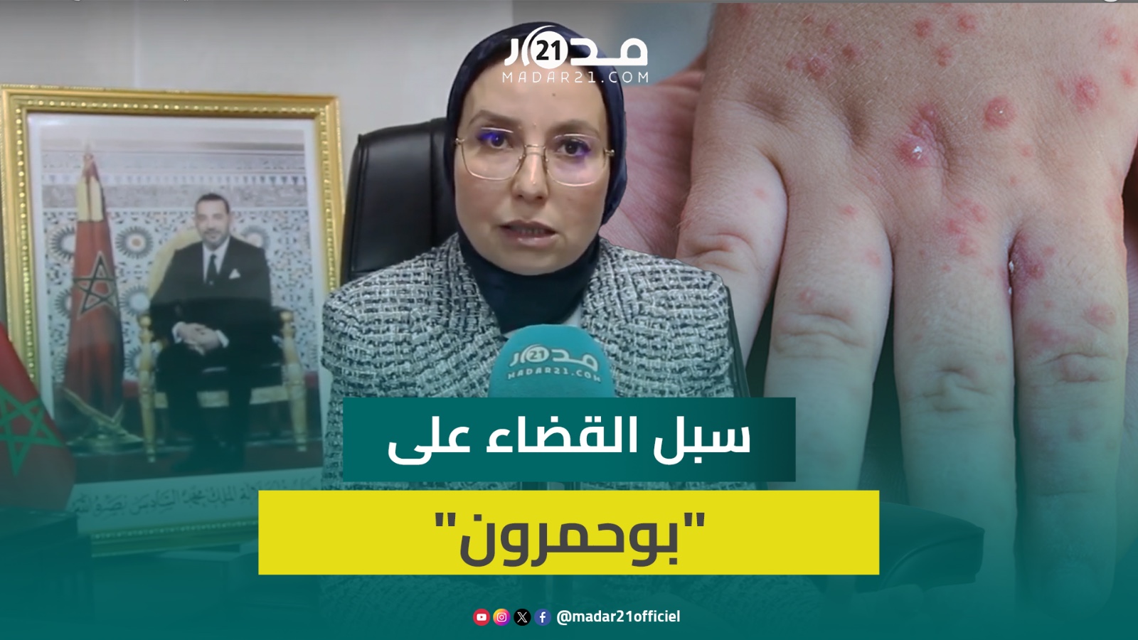 مسؤولة بوزارة الصحة: ارتفاع حالات الإصابة بـ”بوحمرون” يقتضي تكثيف عمليات التلقيح ومراقبة المخالطين