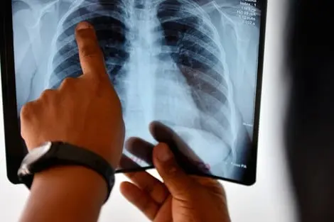 مطالب برلمانية للكشف عن أسباب نقص وانقطاع تزويد مراكز السل بالأدوية