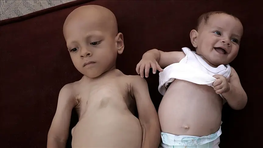 وسط حصار غزة.. الجوع والمرض ينهشان جسدي عبد الله وحبيبة