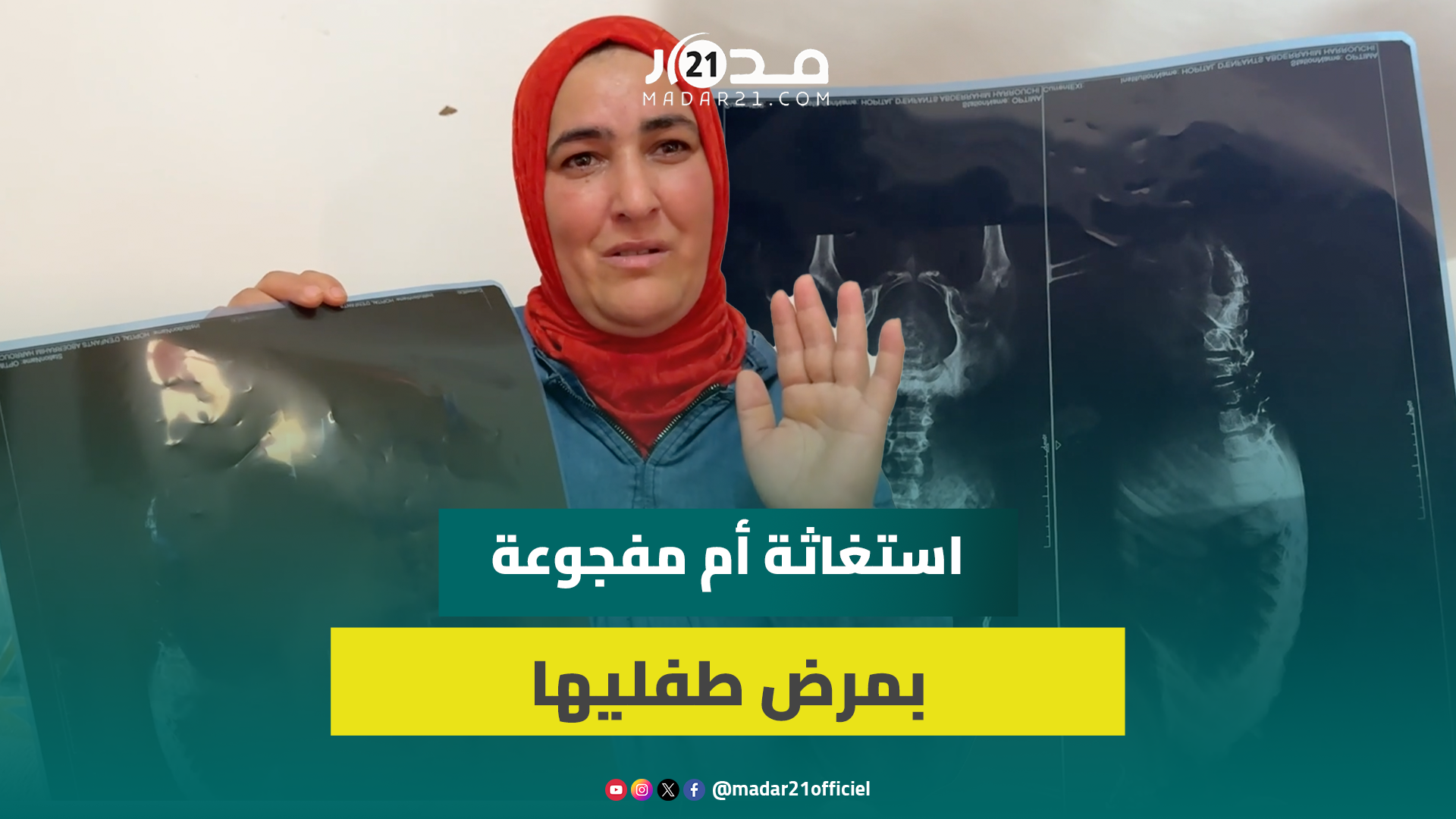 مرض نادر يفجع أسرة متواضعة في فلذتَي كبدها والأم تناشد المحسنين تقديم المساعدة