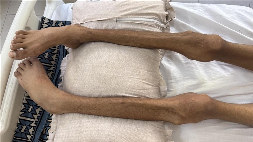 ارتفاع عدد وفيات التجويع الإسرائيلي إلى 435