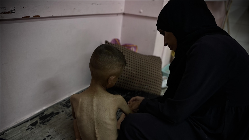 عامان على المجاعة في غزة: بدائل قاسية للبقاء والآلاف تحت وطأة التجويع