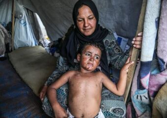 خيام مكتظة ودواء شحيح.. “جدري الماء” يستشري في غزة
