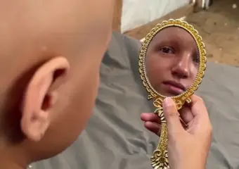 “أحلم أن يعود شعري”.. أمنية طفلة أنهكتها حرب الإبادة بغزة