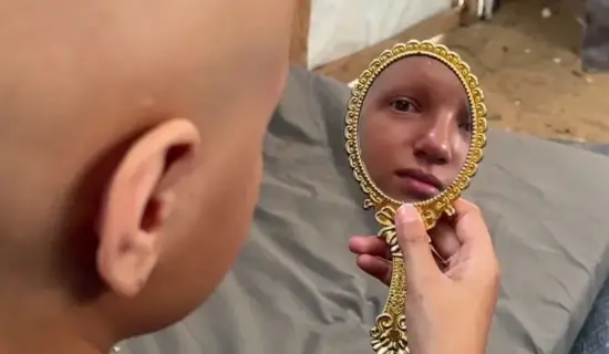 “أحلم أن يعود شعري”.. أمنية طفلة أنهكتها حرب الإبادة بغزة