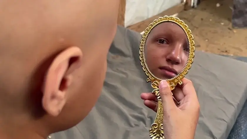 “أحلم أن يعود شعري”.. أمنية طفلة أنهكتها حرب الإبادة بغزة